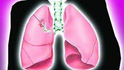 Small cell lung cancer