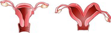 Bicornuate uterus