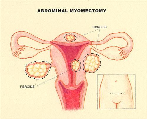 Myomectomy