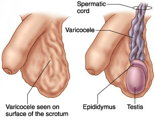 About VARICOCELE-Symptoms,Causes and Treatment of VARICOCELE