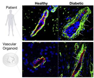 Diabetic blood vessel changes in patients and human vascular organoids. The basement membrane (green) around the blood vessels (red) is massively enlarged in diabetic patients (white arrows). The human vascular organoids that were made “diabetic” in the laboratory can now be used as diabetic model to identify new treatments.
